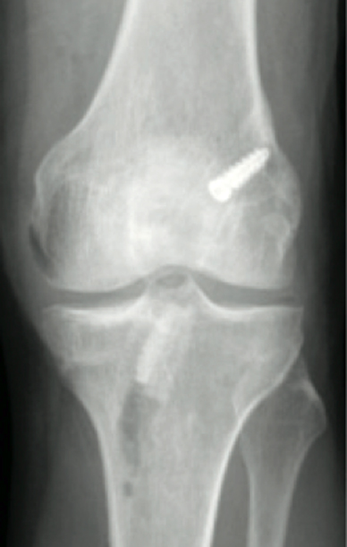 Postoperative radiograph of anterior-posterior view
